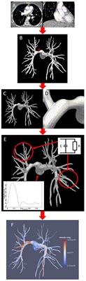 The Use of Biophysical Flow Models in the Surgical Management of Patients Affected by Chronic Thromboembolic Pulmonary Hypertension